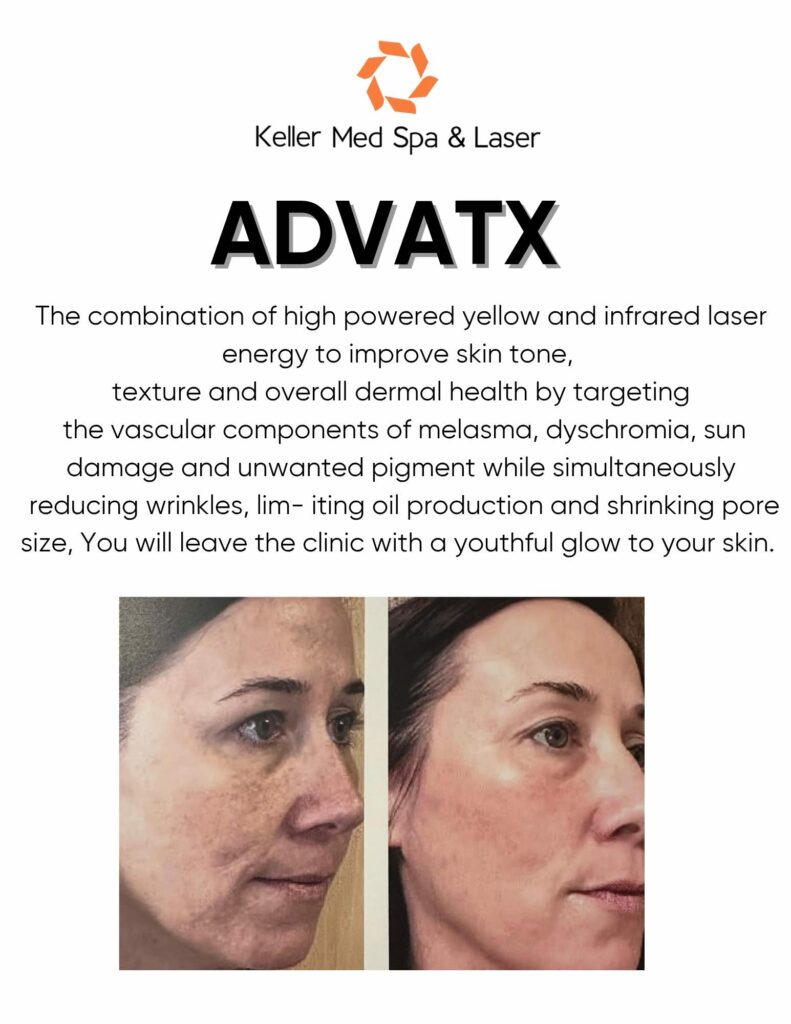 The combination of high powered yellow and infrared laser energy to improve skin tone, texture and overall dermal health by targeting the vascular components of melasma, dyschromia, sun damage and unwanted pigment while simultaneously reducing wrinkles, lim- iting oil production and shrinking pore size, You will leave the clinic with a youthful glow to your skin.