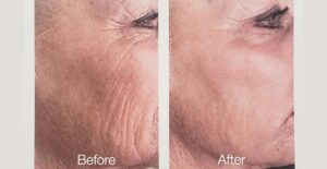 Before and after photographs of a woman showing improvements in skin quality on side of face.