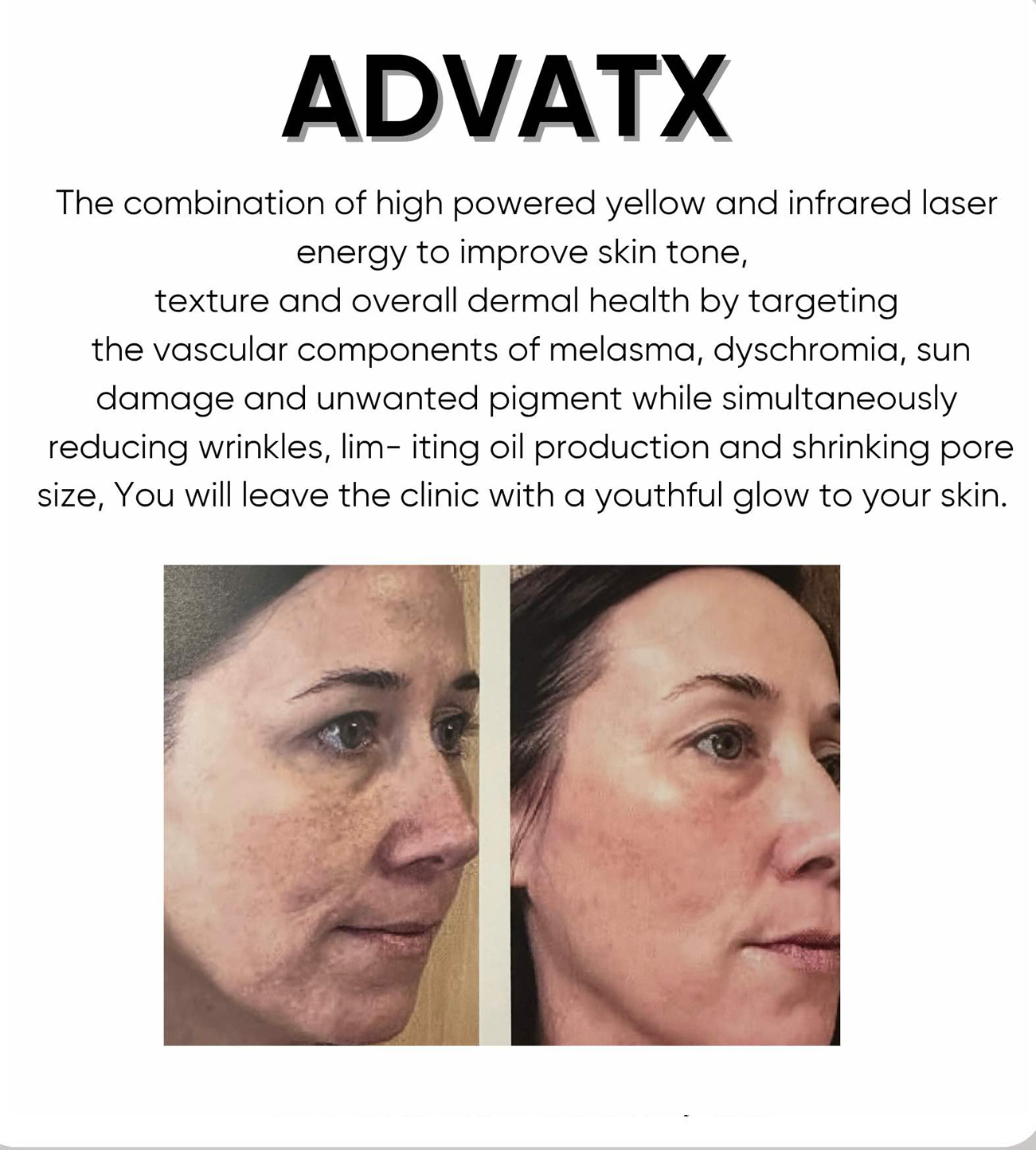 ADVATX